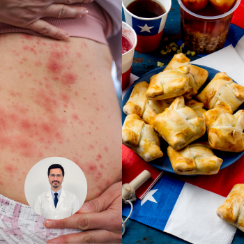 Evita las alergias alimentarias durante estos días de celebración